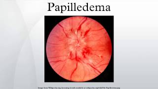 Papilledema [upl. by Janeen]