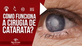 Como funciona a cirurgia de catarata  Dr Marcos de Castro Oftalmologia [upl. by Ayalat944]