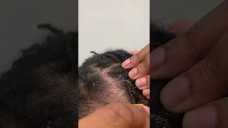 Itchy Scalp  Eczema Flare Up [upl. by Marlie]