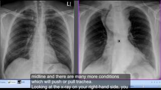 Chest xray Retrosternal Goitre [upl. by Ahsinav952]