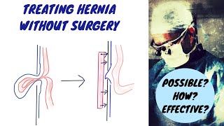 Advanced Hernia Treatment In India  Hernia operation [upl. by Rush]