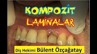 Kompozit Laminalar Doğrudan Teknik Dt Bülent Özçağatay [upl. by Nagad]