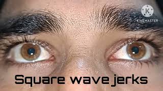 Square wave jerks  movement disorder of eyes [upl. by Fidole]