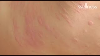 URTICARIA amp HIVES  Causes and Treatment of Itchy Skin Rash [upl. by Maureene]