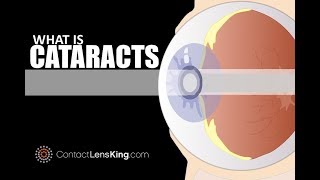 What Causes Cataracts  Symptoms and Treatments [upl. by Aziul625]