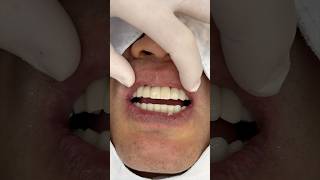 임플란트 세팅과정 dental dentist implantdentist dentalclinic implantdentistry [upl. by Ap]