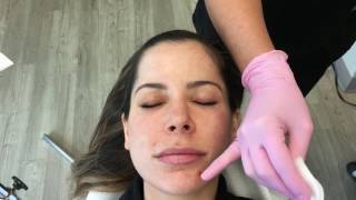 Demonstration of Chemical Peel [upl. by Tiffani]