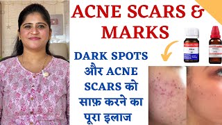 Acne Scars और Pimple Marks का इलाज ॥ Homeopathic medicines to remove Dark spots and Pitting Scars ॥ [upl. by Zimmer]