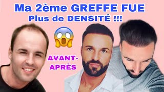 2 ème GREFFE FUE pour plus de VOLUME et de DENSITÉ [upl. by Apps]