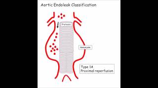 Interventional Radiology Pills  Aortic Endoleak Classification [upl. by Orson300]