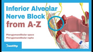 Inferior Alveolar Nerve Block  AZ [upl. by Celtic850]