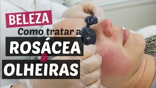 Tratamento para a rosácea com luz pulsada  PARTE 1 [upl. by Bondy]