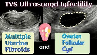 15 th Day TVS Ultrasound  Follicular Cyst  Multiple Uterine Fibroids  Infertility [upl. by Budding]