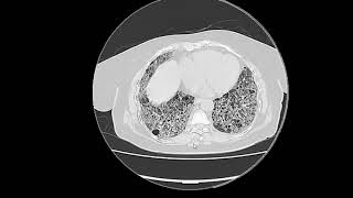 interstitial lung disease [upl. by Aihsenak]