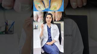 Fungal Infection Treatment holisticare [upl. by Yelhsa461]