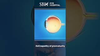 What is retinopathy of prematurity  Retinopathy of prematurity  Eye Treatment  SBH Hospital [upl. by Annawt253]