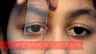 4PD AND 20PD BASE OUT TEST MONOFIXATOR WITH ACT [upl. by Adiuqal]