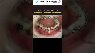 ⏱️ Achieve 3 Years of Orthodontic Treatment in Just 1 Minute 😲 [upl. by Breban702]