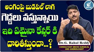 అంగంపై ఇలా ఉందా  Best Treatment For Balanitis  Reason For Penis Infection In Telugu  Androcare [upl. by Orravan93]