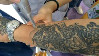 Tattoo removal treatment with picosecond laser machine [upl. by Ahtram744]