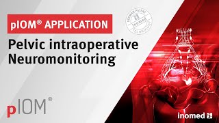 Pelvic Intraoperative Neuromonitoring pIOM  Application  inomed [upl. by Gemperle]