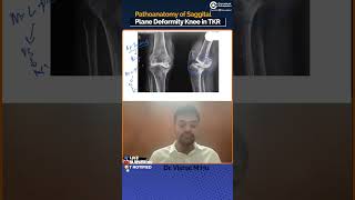 Unlocking Pathoanatomy Saggital Plane Deformity in TKR with Dr Vishal Huggi [upl. by Berard]