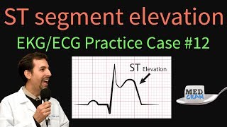 ST Elevation  EKG  ECG Interpretation Case 12 STEMI MI ACS [upl. by Skolnik215]