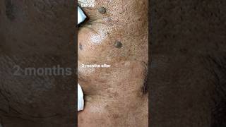 Keratosis Sebhoreik 2 Bulan Setelah Laser CO2 seperti apa keratosis laserco2 shineryaesthetic [upl. by Daffi]