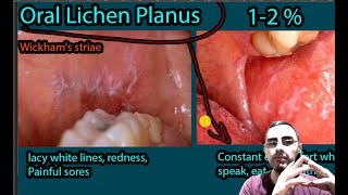 Oral Lichen Planus  Symptoms Causes Treatment Wickhams striae [upl. by Ahsykal]