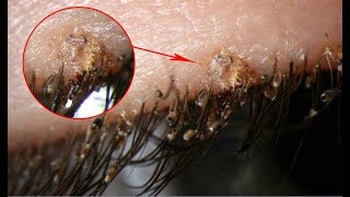 Pubic lice Symptoms – Causes Treatment Signs and Symptoms of Pubic lice and Pubic Crab [upl. by Eytak]