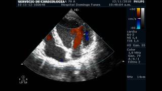 Insuficiencia valvular Aortica  Mitral y Tricuspidea leve Nov 2010 [upl. by Atikehs910]