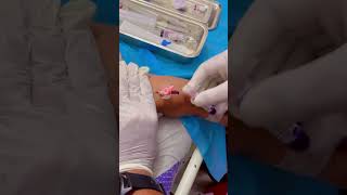 IV Insertion  viral video  Like Share Subscribe amp Follow 👍 [upl. by Haida]