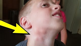 Top 30 Home Remedies For Swollen Lymph Nodes In Neck And Throat [upl. by Brittani996]