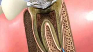 Traitement canal dentaire et pose dun inlaycore [upl. by Notxam]