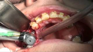 Implante dental con injerto de tejido conectivo [upl. by Hsemar]