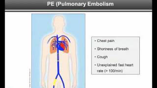 Part 2 Symptoms  DVT and PE What Patients Need to Know [upl. by Neville494]