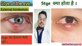 whats are stye  cause  signs and symptoms and Treatment [upl. by Leunammi299]