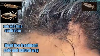 Head lice treatment safe and natural waykuto removalhome remedy remove head lice in a single day [upl. by Anniahs]