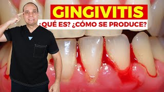 GINGIVITIS 😱 ¿Cómo se produce 😰 ¿Cómo tratarla [upl. by Salis]