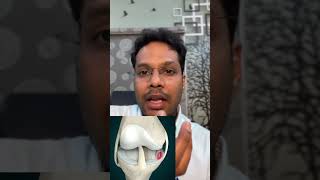 Knee pain  Bakers cyst  Telugu kneepain osteoarthritis shorts [upl. by Joana]