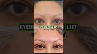 Eyebrow Transformation Procedure [upl. by Grussing]