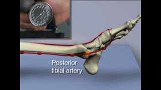 AnkleBrachial Index for Assessment of Peripheral Arterial Disease [upl. by Sehguh]