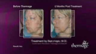 See fantastic before amp after pictures and learn what patients say about Thermage [upl. by Akinam]