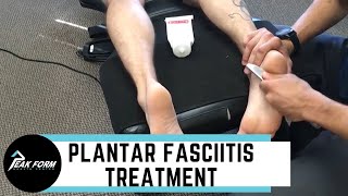 Plantar Fasciitis Treatment San Diego Graston Chiropractic [upl. by Chilt]