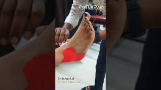 Ankle Sprain Taping  Ankle Stability  Sprained Ankle [upl. by Maleki]