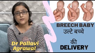 Breech Delivery I Breech Presentation I उल्टे बच्चे की डिलीवरी  नार्मल या आपरेशन [upl. by Warrick]