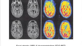 NonAlzheimers Disease Dementias [upl. by Mckenna]