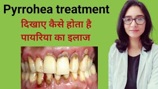 Pyrrohea treatmentपायरिया का इलाजपायरिया का इलाज कैसे होता हैमसूड़ों के बीमारी कैसे ठीक करे [upl. by Kan]