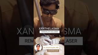 Xanthelasma Removal by CO2 Laser  Fat deposit removal treatment xanthelasma shortvideo skincare [upl. by Janek]