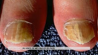 Jai honte de mes ongles de pieds que faire   Le Magazine de la santé [upl. by Haeli70]